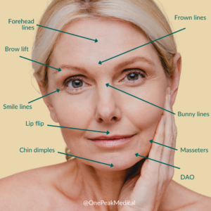 Descriptive image with text callouts of areas where cosmetic Botox can be administered to reduce signs of aging.